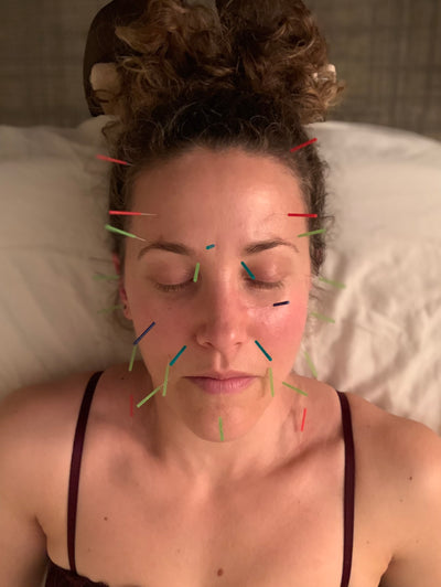 All the Goods on Facial Acupuncture
